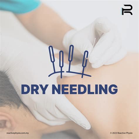 Exploring the Art of Healing: The Introduction of Dry Needling ...