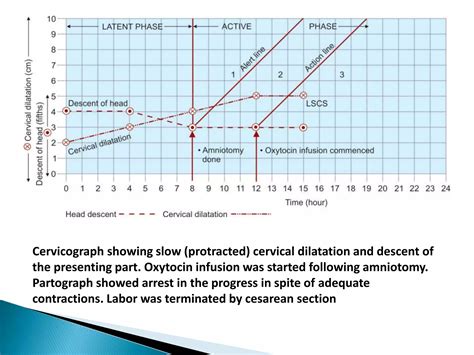 Partograph | PPTX