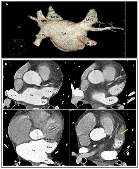 Multimodality Imaging in the Study of the Left Atrium