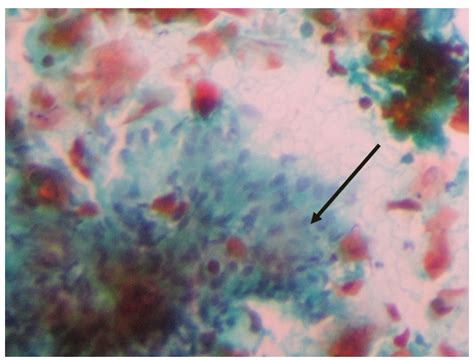 A Comparative Study of Endoscopic Biopsy and Endoscopic FNAC in ...