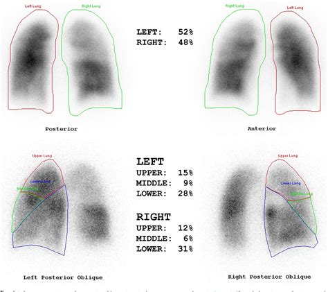 What Is A Lung Ventilation/Perfusion Scan at Stan Denham blog