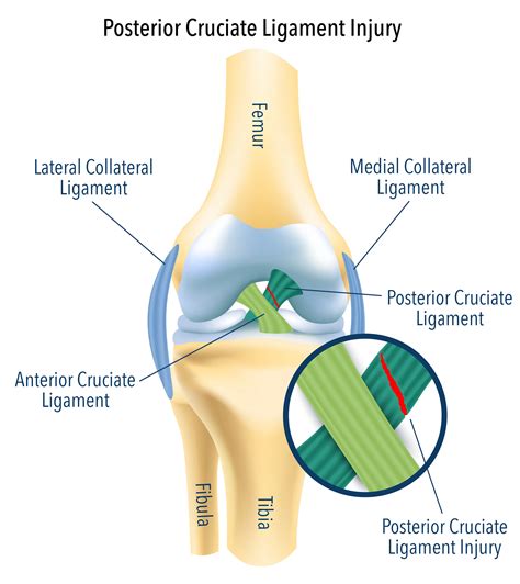 Posterior Cruciate Ligament Injury Treatment | PCL Surgery Melbourne