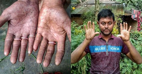 The Men In This Family Have No Fingerprints