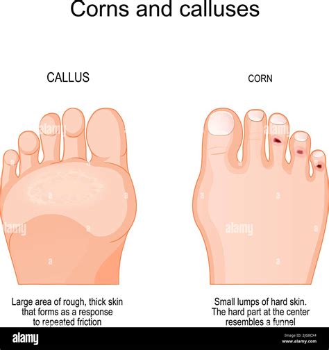 Corns and calluses foot Stock Vector Images - Alamy