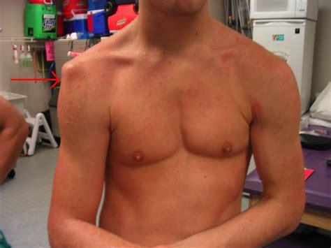 Sulcus Sign Explained 的图像结果