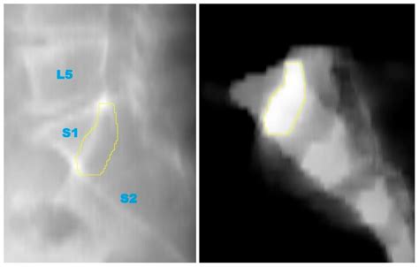 Ramadanov–Zabler Safe Zone for Sacroiliac Screw Placement: A CT-Based ...