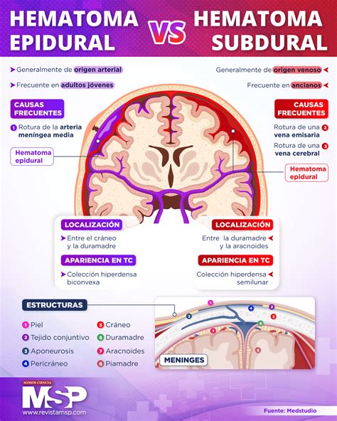 Hematoma epidural VS hematoma subdural