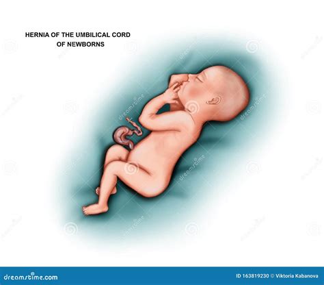 Umbilical Cord Hernia