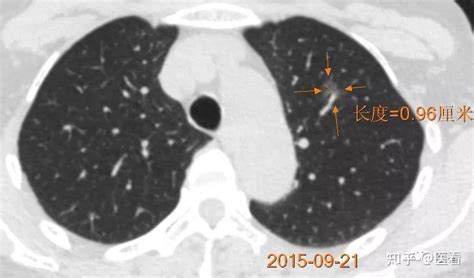 肺磨玻璃结节是肺癌吗？遇到肺磨玻璃结节莫惊慌 - 知乎