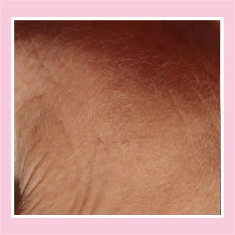 Thinning Skin Treatments - Dermal Health London