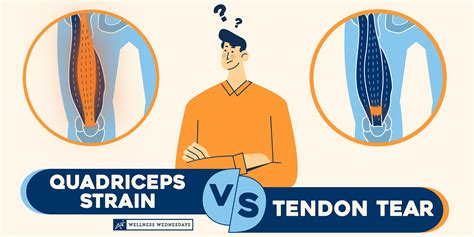 Quadriceps Strain Treatment, Causes, Symptoms, and Diagnosis | Airrosti