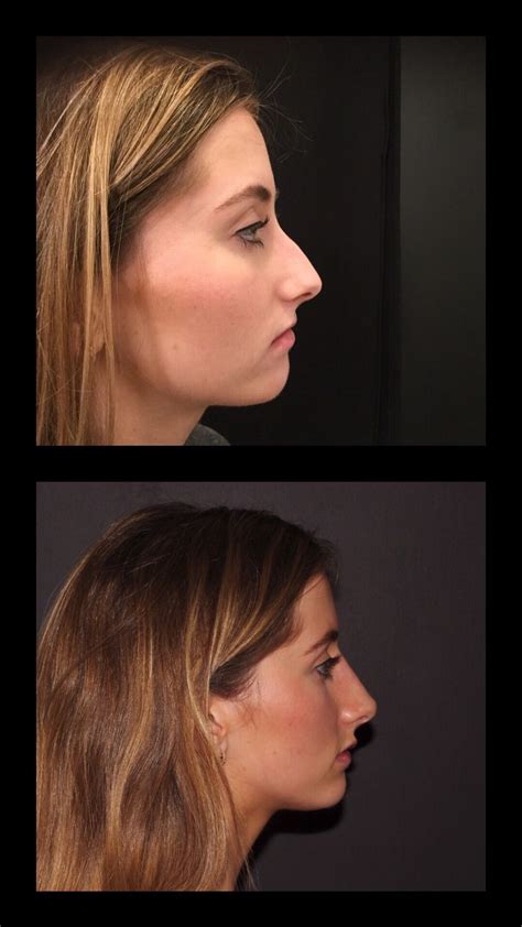 Non-surgical nose job | Nose job, Nose fillers, Rhinoplasty nose jobs