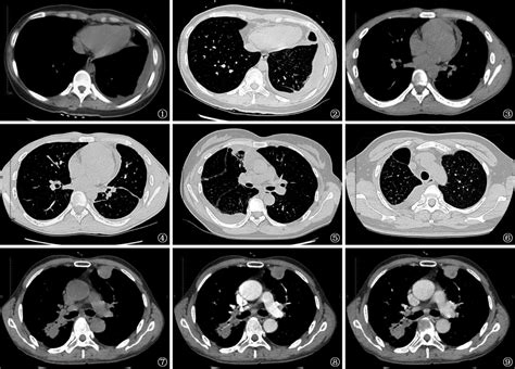 结核性胸膜炎发病早期的CT征象及其动态变化特点的分析