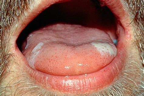 舌炎的症状图片 (7)_有来医生