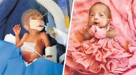 Preterm baby with complications goes back home healthy