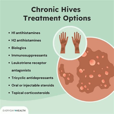 Switching Medications: What to Do if Urticaria (Chronic Spontaneous ...