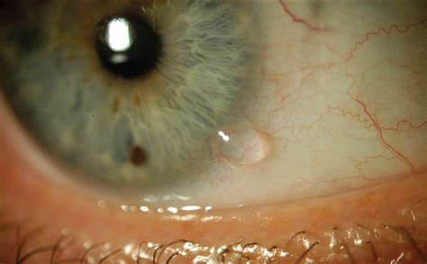 Conjunctival Retention Cyst