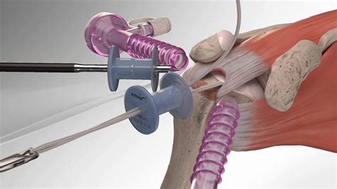 Image result for Rotator Cuff Repair Photo