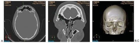 The Comprehensive AOCMF Classification System: Radiological Issues and ...