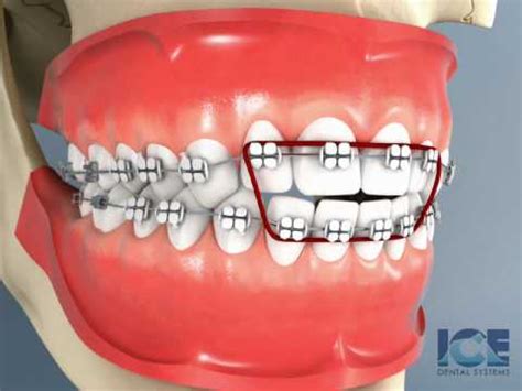 Anterior Open bite Braces Video Lecture - Dental