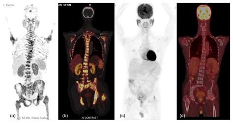 PSMA Receptor-Based PET-CT: The Basics and Current Status in Clinical and Research Applications