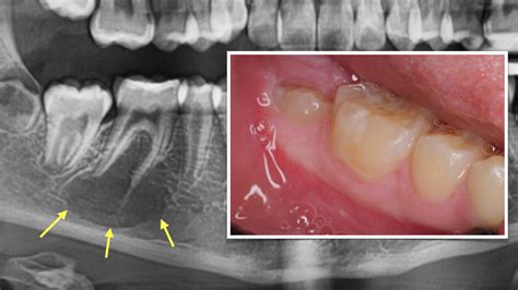 Traumatic Bone Cyst Jaw Bony Lesions | IntechOpen
