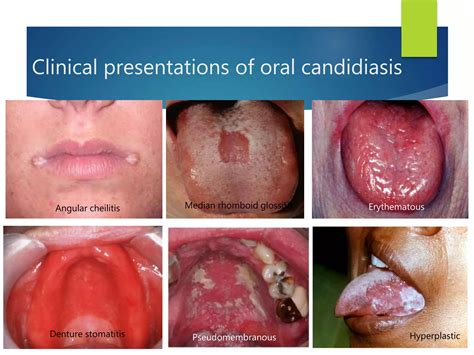 Oral mucosal lesions | PPTX