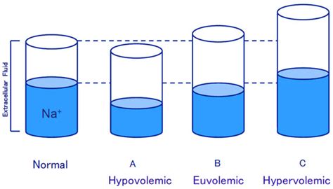 Is Exaggerated Release of Arginine Vasopressin an Endocrine Disorder ...