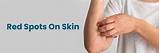 Manchas rojas en la piel: causas, tipos, tratamiento y prevención