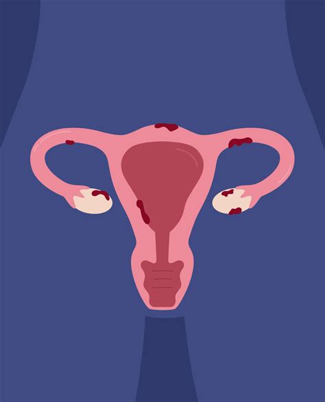 Endometriosis: causes, symptoms and treat.. - SynappseHealth
