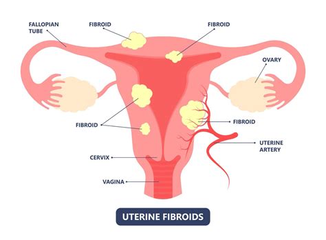 What is the Difference Between Fibroids and Ovarian Cysts? | AFC