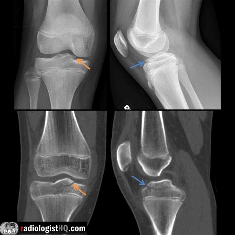 Salter III tibial plateau epiphyseal fracture in pediatric patient on ...