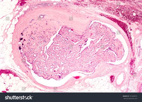 Microscopic Image Intraductal Papilloma Type Benign Stock Photo (Edit Now) 791683072