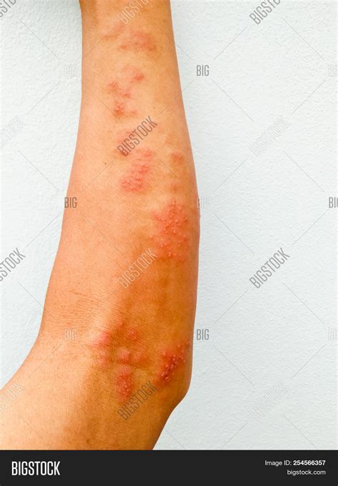 Herpes On Arms