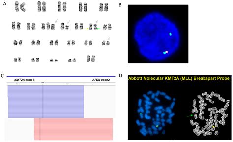 Cryptic KMT2A::AFDN Fusion Due to AFDN Insertion into KMT2A in a ...