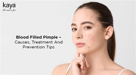 Image result for Blood Red Pimple