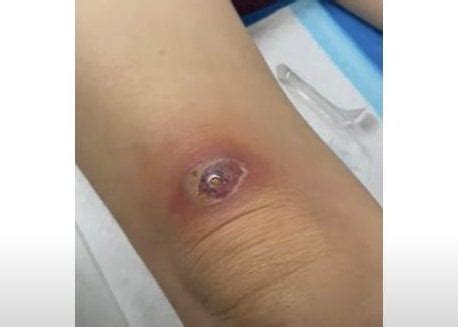 Image result for Exploding Massive Knee Abscess