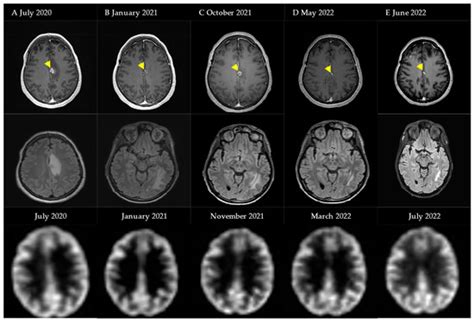 Low-Dose Bevacizumab for the Treatment of Focal Radiation Necrosis of ...