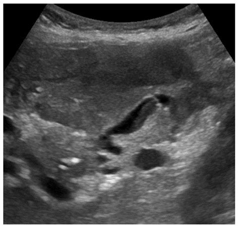 New Developments in the Ultrasonography Diagnosis of Gallbladder Diseases