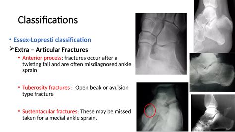 CALCANEAL FRACTURES PPT and JOURNAL.pptx