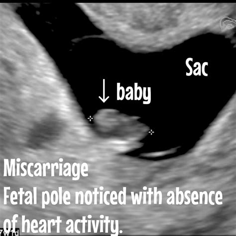 All you need to know about miscarriages. - Ultrasoundfeminsider
