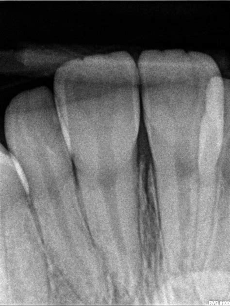 Periapical X Ray