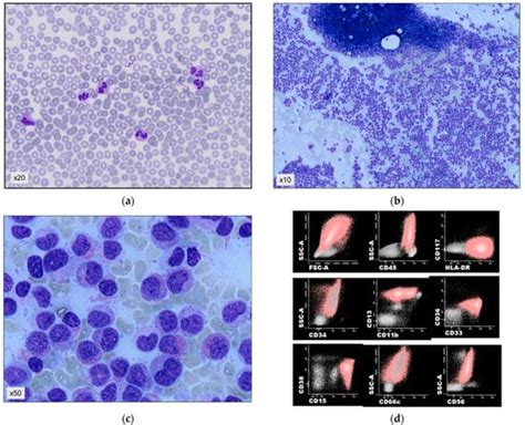 Infrequent Presentations of Chronic NPM1-Mutated Myeloid Neoplasms ...