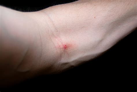 Infected Heroin Track Marks What Are Track Marks? An Informative Guide