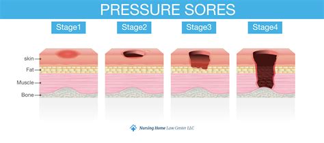 Skin Ulcer Stage 1 Pressure Ulcers