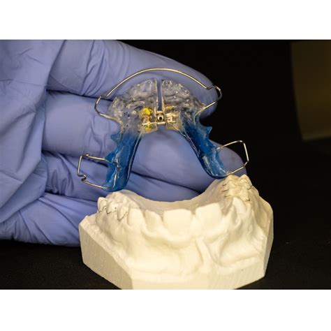 How To Adjust Palate Expander