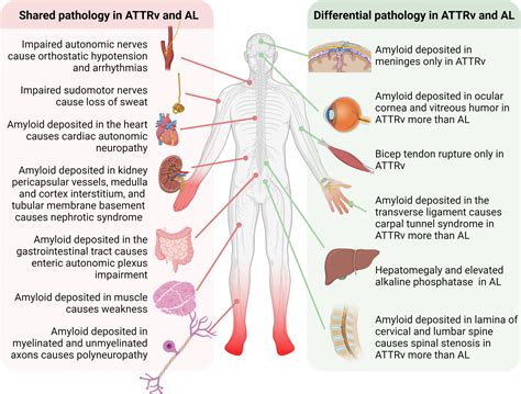 Amyloid Neuropathy: From Pathophysiology to Treatment in Light‐Chain Amyloidosis and Hereditary ...