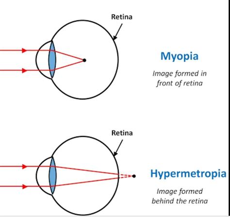 Name the defect vision due to a) Excesive curvature of eye lens b ...