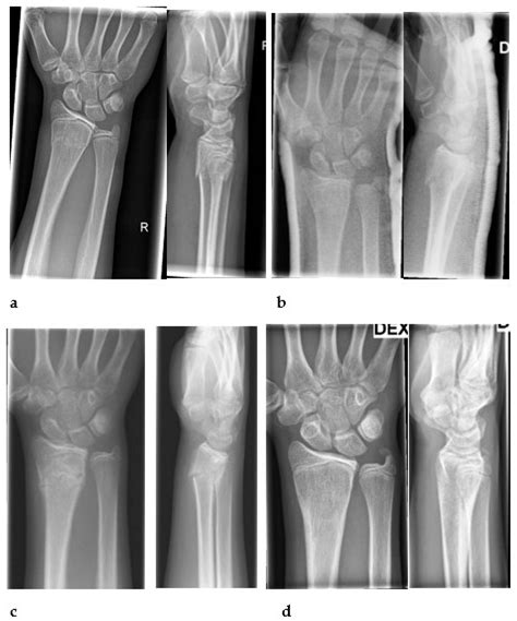 Ulna Wrist Fracture