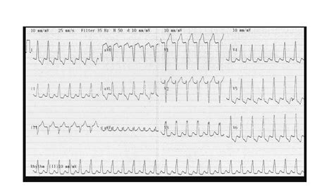 Image result for Wide Complex Tachycardia Algorithm